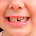 Надо ли лечить молочные зубы?