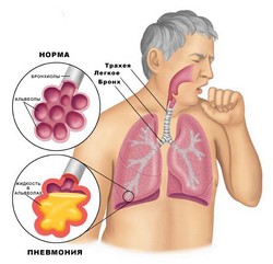 Признаки пневмонии и опасность бессимптомного ее протекания