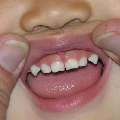 Надо ли лечить молочные зубы?